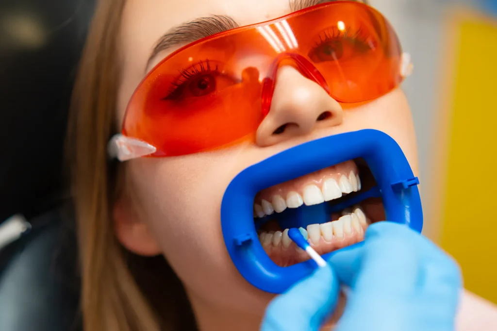 Applicazione del gel sbiancante durante una seduta di sbiancamento dentale professionale in studio